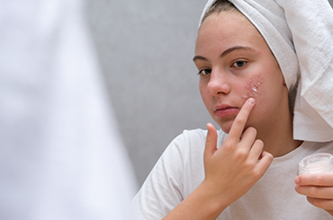 How to fight with Pesky Pimples