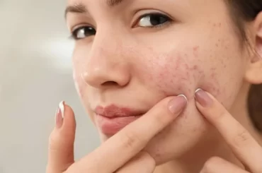 How to Get Rid of Acne at Home?