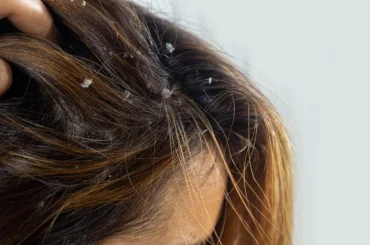 How to Get Rid of Dandruff and Itchy Scalp?